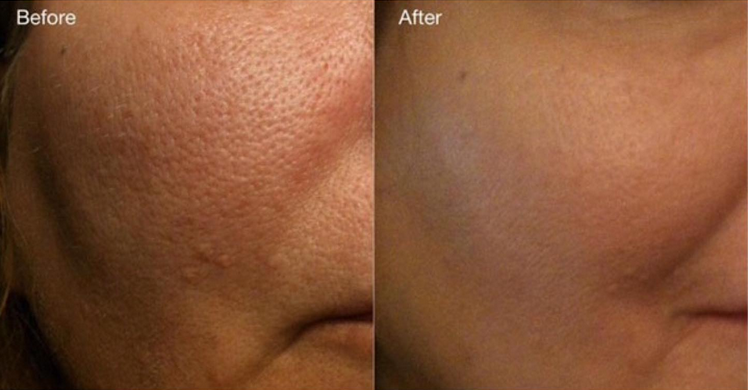 A before and after photo of a persons face after receiving carbon laser facial