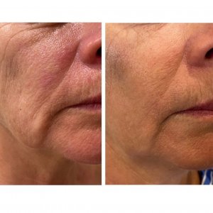 A ladys face shown twice before and after HiFu skin tightening treatent.