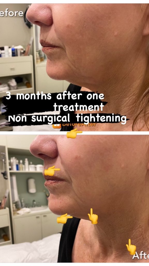 A ladies face comparing her skin from her first hifu treatment and 3 month's later.