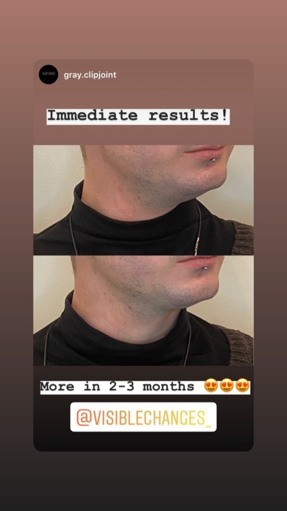 A mans face showing immediate results from first Hifu treatment