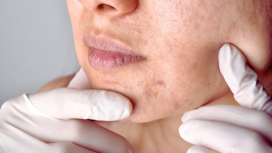 5 Most Effective Treatments and Regimens Against Acne