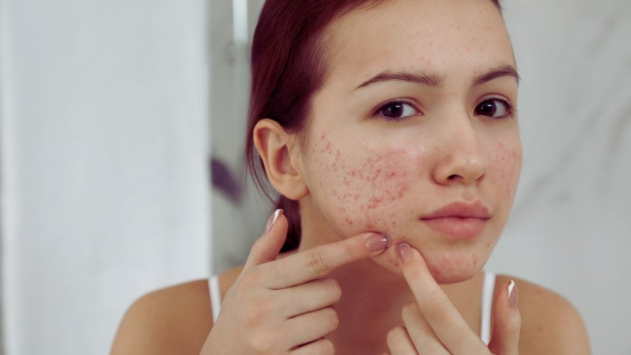 Acne 101 Definition, Causes, Treatments, and Prevention