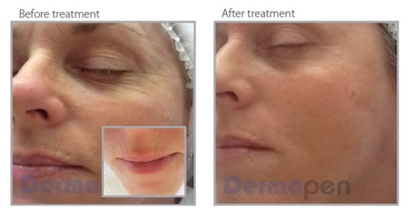 Before and after treatment photo using DermaPen 