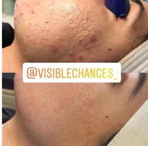 Derma Needling before and after treating acne on face